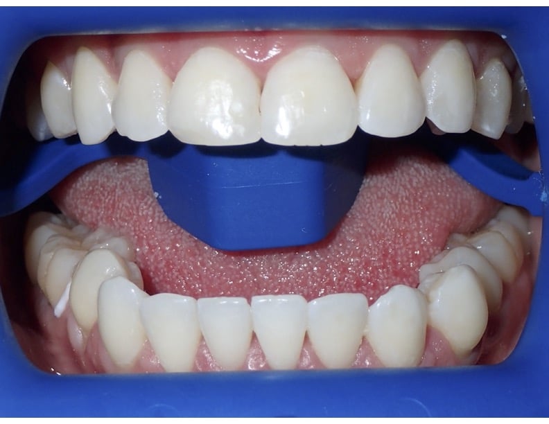 After picture of patient before Zoom Whitening at OX Orthodontix