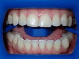 Before picture of patient before Zoom Whitening at OX Orthodontix