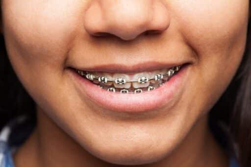 girl smiling with LightForce braces 