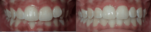 Before and after Invisalign with OX Orthodontix