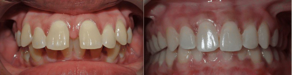 Dramatic before and after with OX Orthodontix Invisalign